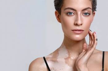 Стандарты лечения витилиго изменятся к лучшему уже в ближайшем будущем