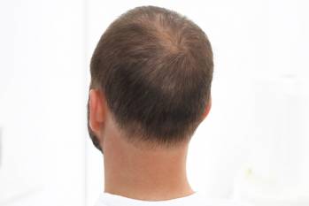 Барицитиниб признан прорывной терапией очаговой алопеции