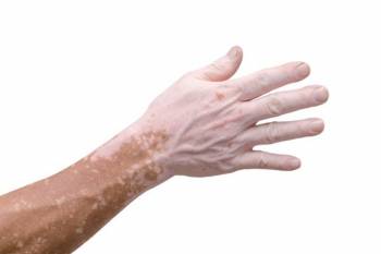 UVB-фототерапия витилиго не связана с риском развития рака кожи