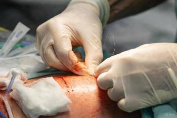 Післяопераційні ускладнення та фактори ризику при видаленні шкірних пухлин з простим накладанням швів під місцевою анестезією